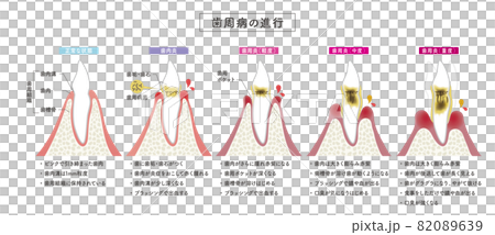 Progression of periodontal disease 82089639