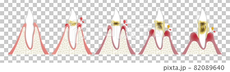Progression of periodontal disease 82089640
