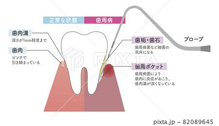 プローブで歯周病のチェックをするイラスト プローブで歯周病のチェックをするイラスト 82089645