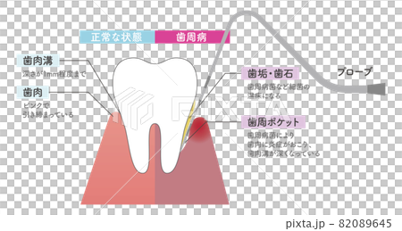 プローブで歯周病のチェックをするイラスト プローブで歯周病のチェックをするイラスト 82089645