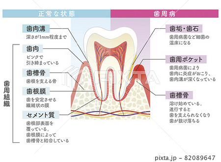 歯周病と正常な状態の比較図のイラスト素材 0647