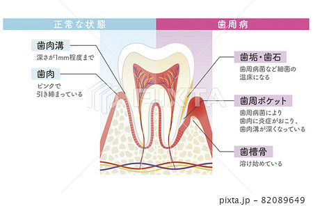 歯周病と正常な状態の比較図 82089649