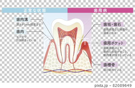 歯周病と正常な状態の比較図 82089649