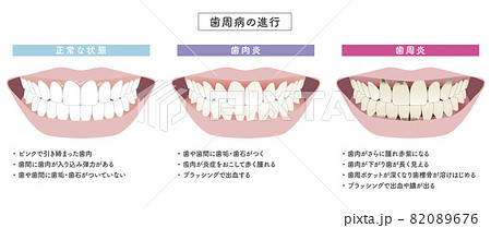 歯周病の進行　イラストセット 82089676