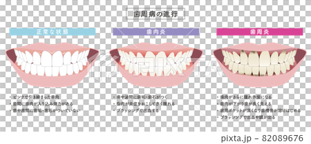 歯周病の進行　イラストセット 82089676