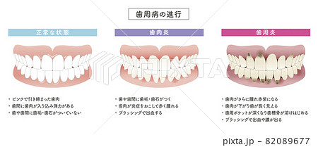 歯周病の進行　イラストセット 82089677