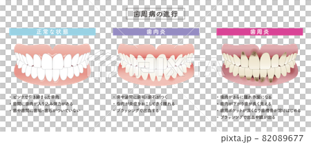 歯周病の進行　イラストセット 82089677