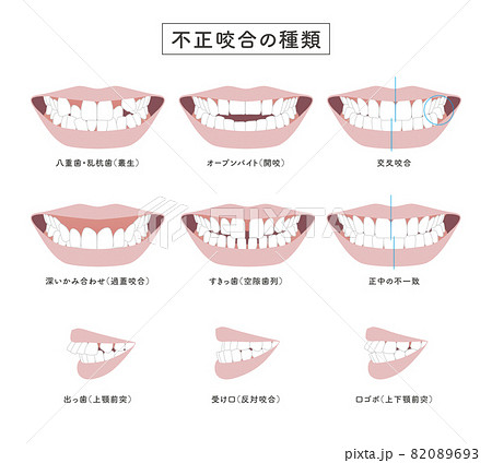 不正咬合の種類　セットイラスト 82089693