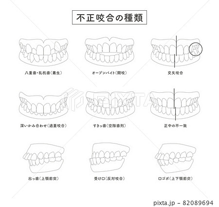 不正咬合の種類 セットイラストのイラスト素材 0694