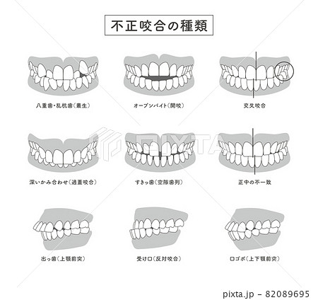不正咬合の種類　セットイラスト 82089695