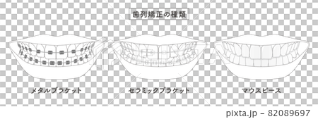 歯列矯正の種類　セットイラスト 82089697