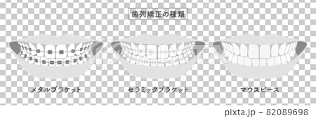 歯列矯正の種類　セットイラスト 82089698