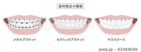 歯列矯正の種類　セットイラスト 82089699