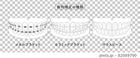 歯列矯正の種類　セットイラスト 82089700