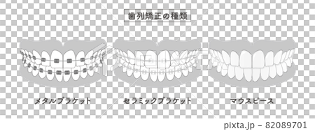 歯列矯正の種類　セットイラスト 82089701