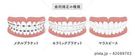 歯列矯正の種類 セットイラストのイラスト素材 0702