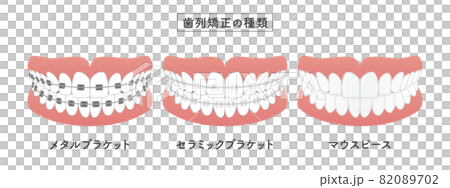 正畸類型設置圖 82089702