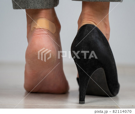 A woman in black shoes puts a plaster on a corn 82114070