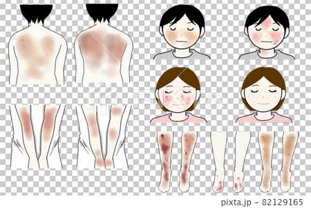 皮膚炎の症状イラスト 82129165