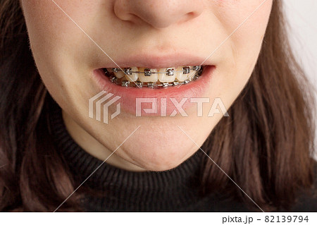 Orthodontic treatment. Dental care concept. Smiling teenage girl with braces. Metal braces close-up on the teeth. Orthodontic treatment. Dental care concept. Smiling teenage girl with braces. Metal braces close-up on the teeth. 82139794