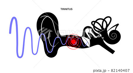 Tinnitus disease concept Tinnitus disease concept 82140407