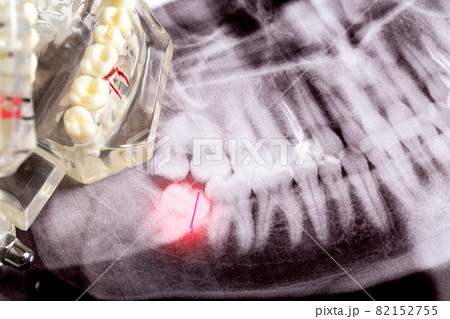 Impacted wisdom teeth on an X-ray picture with an inflamed cyst neoplasm. Removal of wisdom teeth in dentistry. Pericoronaritis Impacted wisdom teeth on an X-ray picture with an inflamed cyst neoplasm. Removal of wisdom teeth in dentistry. Pericoronaritis 82152755