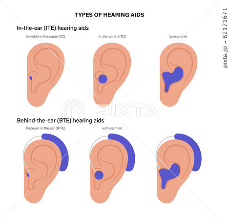 Hearing aids types 82171671
