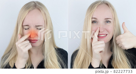 Before and after. On the left, the woman indicates nose pain, and on the right, indicates that nose no longer hurts. Professional medical care assistance concept. Treatment of allergies and nosebleeds Before and after. On the left, the woman indicates nose pain, and on the right, indicates that nose no longer hurts. Professional medical care assistance concept. Treatment of allergies and nosebleeds 82227733