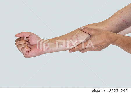 毛虫に刺されて赤く腫れる腕のアップ 毛虫に刺されて赤く腫れる腕のアップ 82234245