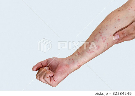 毛虫に刺されて赤く腫れる腕のアップ 毛虫に刺されて赤く腫れる腕のアップ 82234249