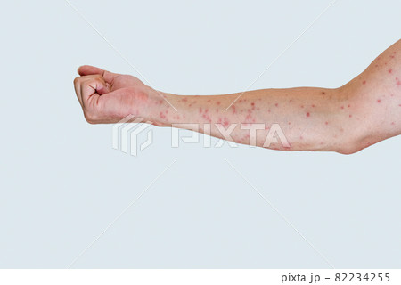 毛虫に刺されて赤く腫れる腕のアップ 毛虫に刺されて赤く腫れる腕のアップ 82234255