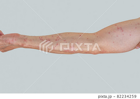 毛虫に刺されて赤く腫れる腕のアップ 毛虫に刺されて赤く腫れる腕のアップ 82234259