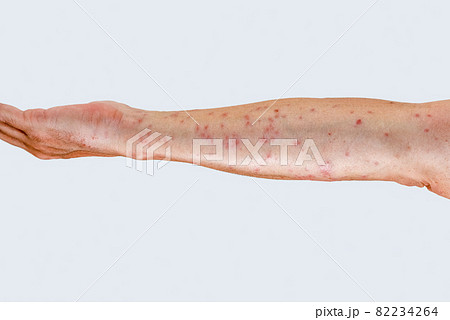 毛虫に刺されて赤く腫れる腕のアップ 82234264