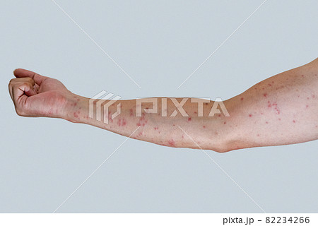 毛虫に刺されて赤く腫れる腕のアップ 82234266