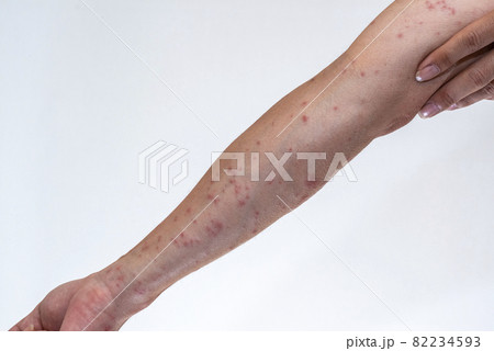 毛虫に刺されて赤く腫れる腕のアップ 82234593
