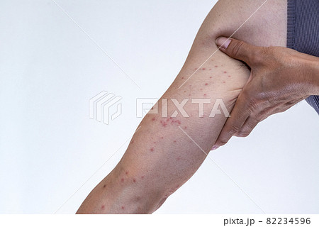 毛虫に刺されて赤く腫れる腕のアップ 毛虫に刺されて赤く腫れる腕のアップ 82234596