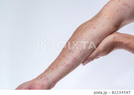 毛虫に刺されて赤く腫れる腕のアップ 82234597