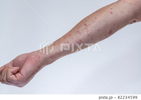 毛虫に刺されて赤く腫れる腕のアップ 毛虫に刺されて赤く腫れる腕のアップ 82234599