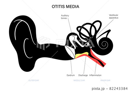 otitis media disease 82243384