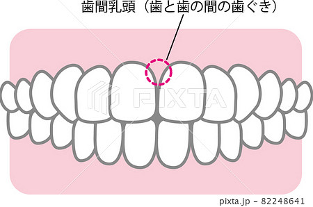 歯間乳頭のイラスト 82248641