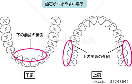 歯石のつきやすい場所のイラスト 歯石のつきやすい場所のイラスト 82248642