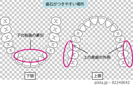 歯石のつきやすい場所のイラスト 歯石のつきやすい場所のイラスト 82248642