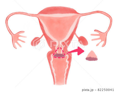 子宮頸がんの円錐切除術の水彩イラスト 82250041
