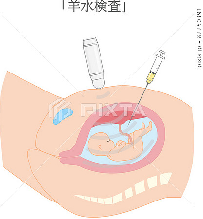 妊婦さんの羊水検査の図解イラストですのイラスト素材