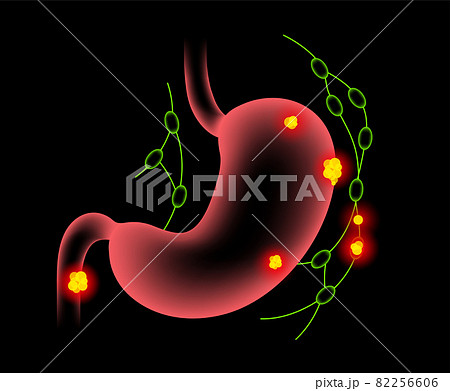Stomach cancer anatomy 82256606