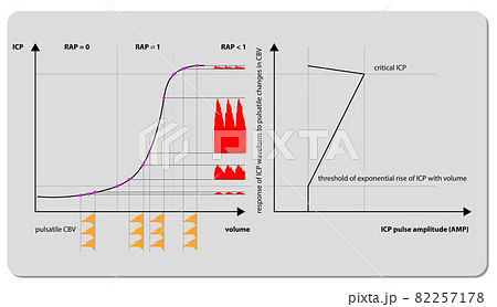 Intracranial Pressure Monitoring ICP waveform, 3d render, 2d graphic Intracranial Pressure Monitoring ICP waveform, 3d render, 2d graphic 82257178