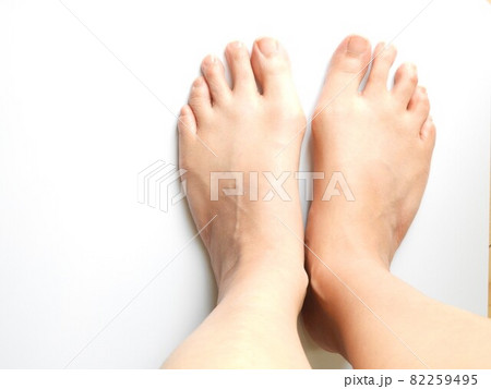 外反母趾1 82259495