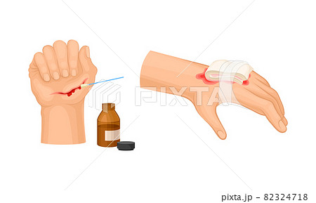Skin burn injury treatment. Hurt human hand with first aid bandage vector illustration Skin burn injury treatment. Hurt human hand with first aid bandage vector illustration 82324718