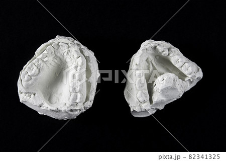 Teeth cast mold of the jaw made of plaster for orthodonist work 82341325
