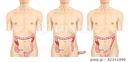 イラスト素材：直腸・S状結腸がん004（リアル） 82341996